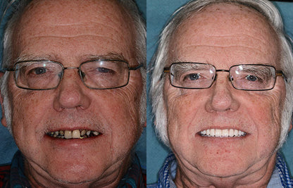 HOOMWELL™ --🦷Advanced Customized Full Denture Set🍎