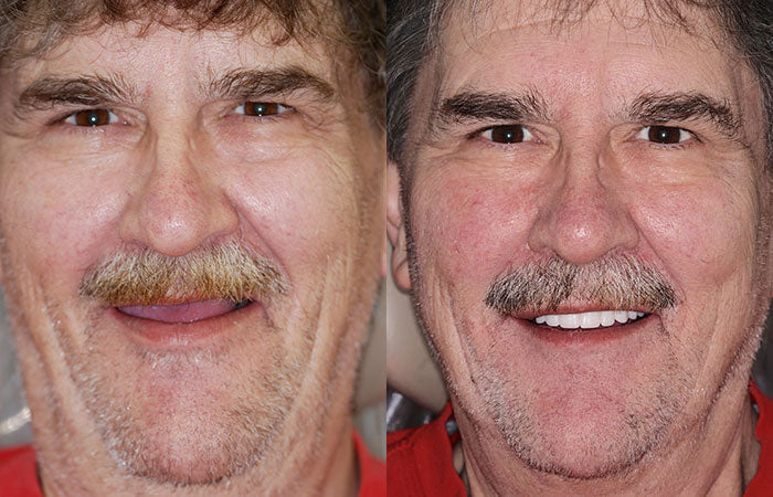 HOOMWELL™ --🦷Advanced Customized Full Denture Set🍎
