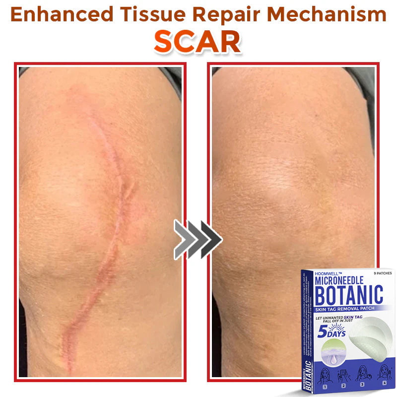 🌈HOOMWELL™ MicroNeedle Botanic Skin Tag Removal Patch 🇺🇸 Made in the USA