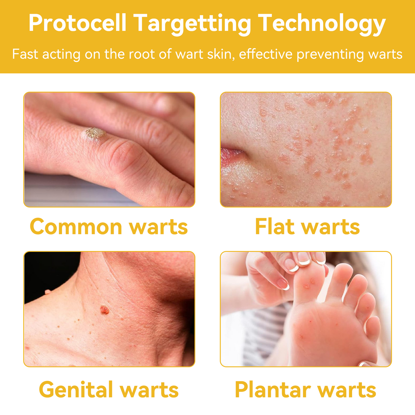 🔥 Save Up to 65% – HOOMWELL™ Gentle Skin Tag & Wart Removal Spray with Tea Tree Oil