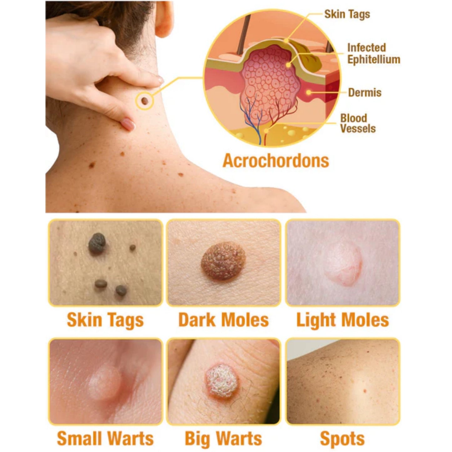 🔥 Save Up to 65% – HOOMWELL™ Gentle Skin Tag & Wart Removal Spray with Tea Tree Oil