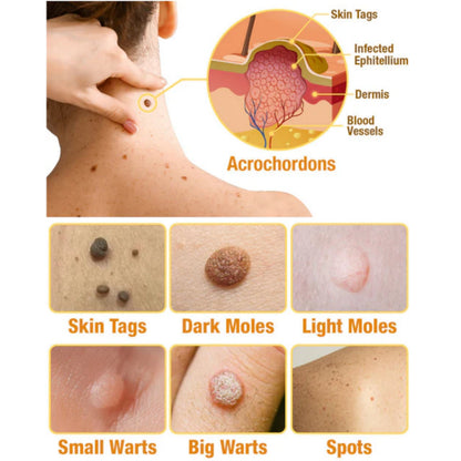 🔥 Save Up to 65% – HOOMWELL™ Gentle Skin Tag & Wart Removal Spray with Tea Tree Oil