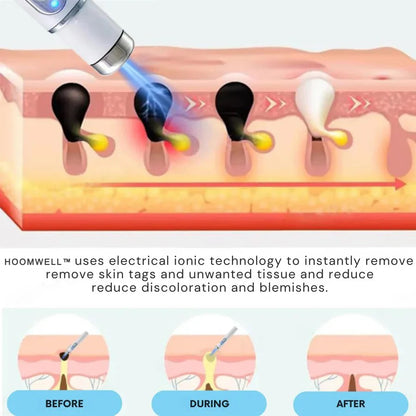 🔥【OFFICIAL STORE】HOOMWELL™ Non-Invasive Mole and Wart Removal Laser Pen