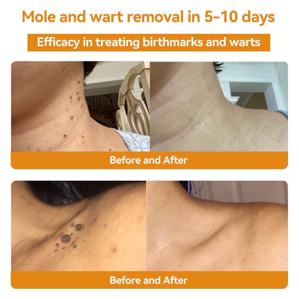 🔥 Save Up to 65% – HOOMWELL™ Gentle Skin Tag & Wart Removal Spray with Tea Tree Oil