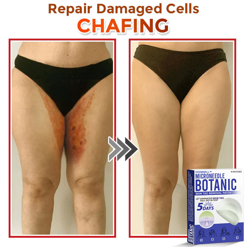 🌈HOOMWELL™ MicroNeedle Botanic Skin Tag Removal Patch 🇺🇸 Made in the USA