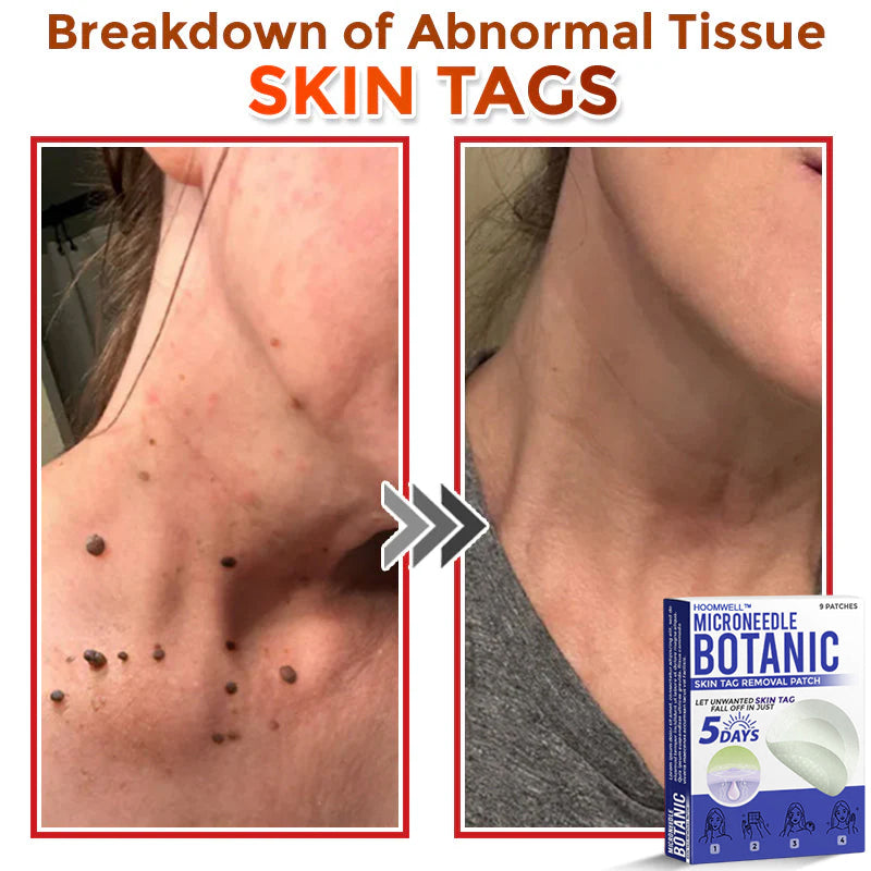 🌈HOOMWELL™ MicroNeedle Botanic Skin Tag Removal Patch 🇺🇸 Made in the USA