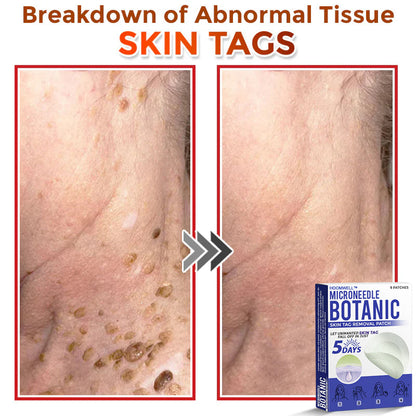 🌈HOOMWELL™ MicroNeedle Botanic Skin Tag Removal Patch 🇺🇸 Made in the USA