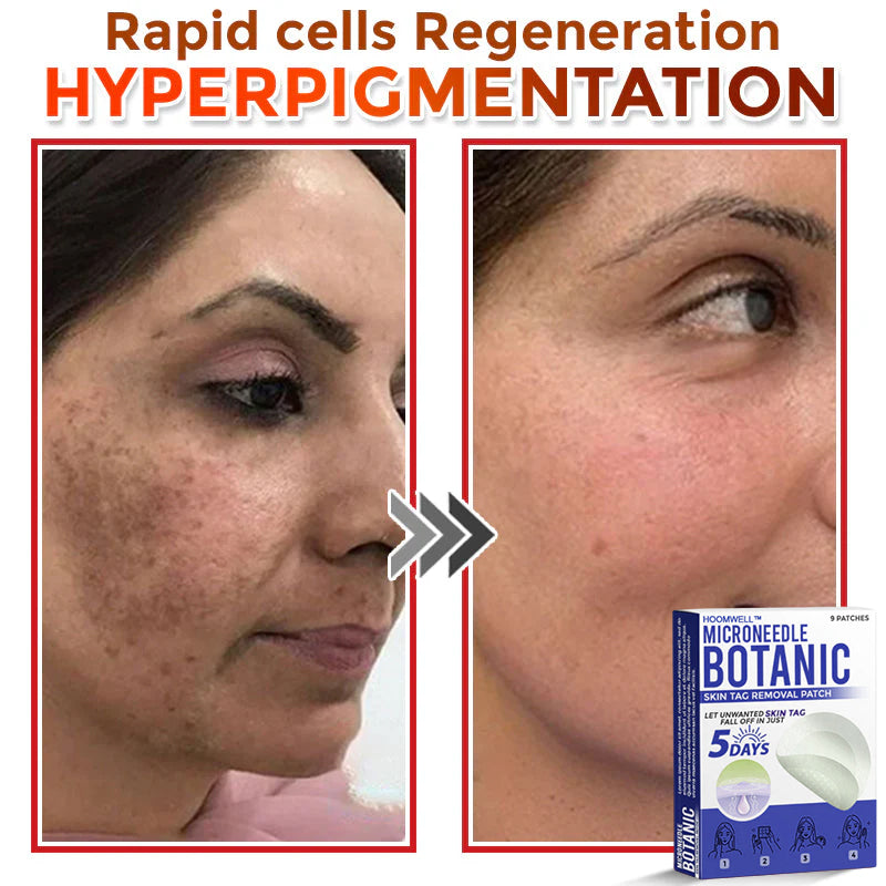 🌈HOOMWELL™ MicroNeedle Botanic Skin Tag Removal Patch 🇺🇸 Made in the USA