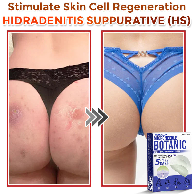 🌈HOOMWELL™ MicroNeedle Botanic Skin Tag Removal Patch 🇺🇸 Made in the USA