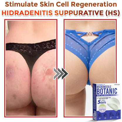 🌈HOOMWELL™ MicroNeedle Botanic Skin Tag Removal Patch 🇺🇸 Made in the USA