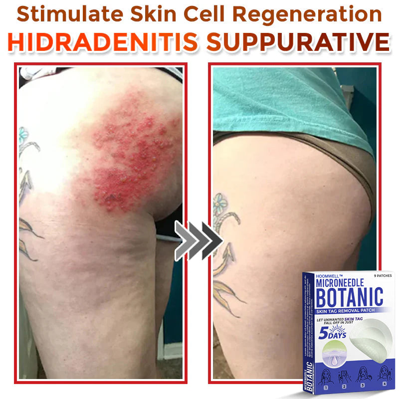 🌈HOOMWELL™ MicroNeedle Botanic Skin Tag Removal Patch 🇺🇸 Made in the USA