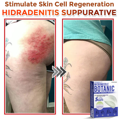 🌈HOOMWELL™ MicroNeedle Botanic Skin Tag Removal Patch 🇺🇸 Made in the USA