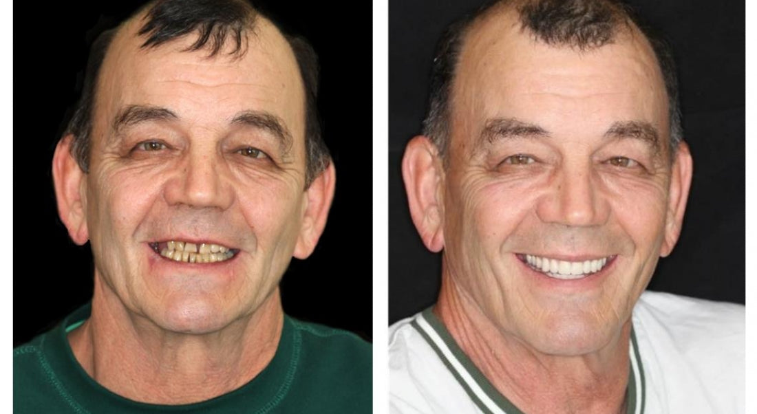 HOOMWELL™ --🦷Advanced Customized Full Denture Set🍎