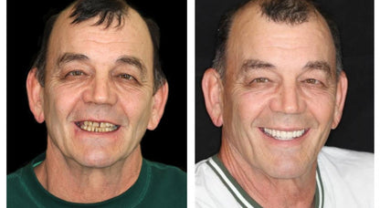 HOOMWELL™ --🦷Advanced Customized Full Denture Set🍎