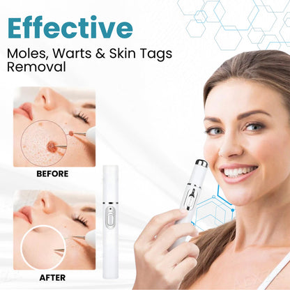 🔥【OFFICIAL STORE】HOOMWELL™ Non-Invasive Mole and Wart Removal Laser Pen