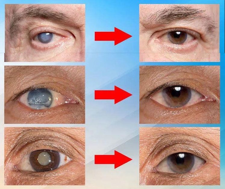 ⏰FLASH SALE: 69% OFF🔥— Japan Vision Drops — Rapidly Heals All Eye Conditions & Restores Vision