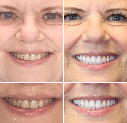 HOOMWELL™ --🦷Advanced Customized Full Denture Set🍎