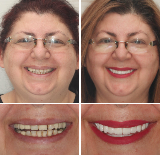HOOMWELL™ --🦷Advanced Customized Full Denture Set🍎