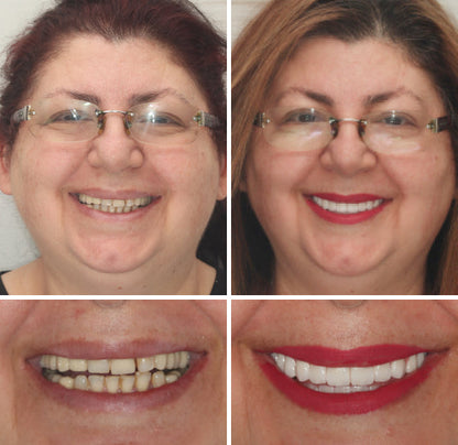 HOOMWELL™ --🦷Advanced Customized Full Denture Set🍎