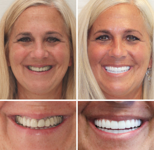 HOOMWELL™ --🦷Advanced Customized Full Denture Set🍎