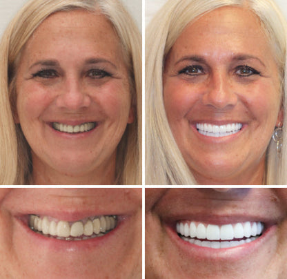 HOOMWELL™ --🦷Advanced Customized Full Denture Set🍎